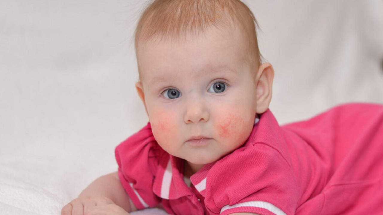 Alerjik hastalıklarda ilk basamak besin alerjisi