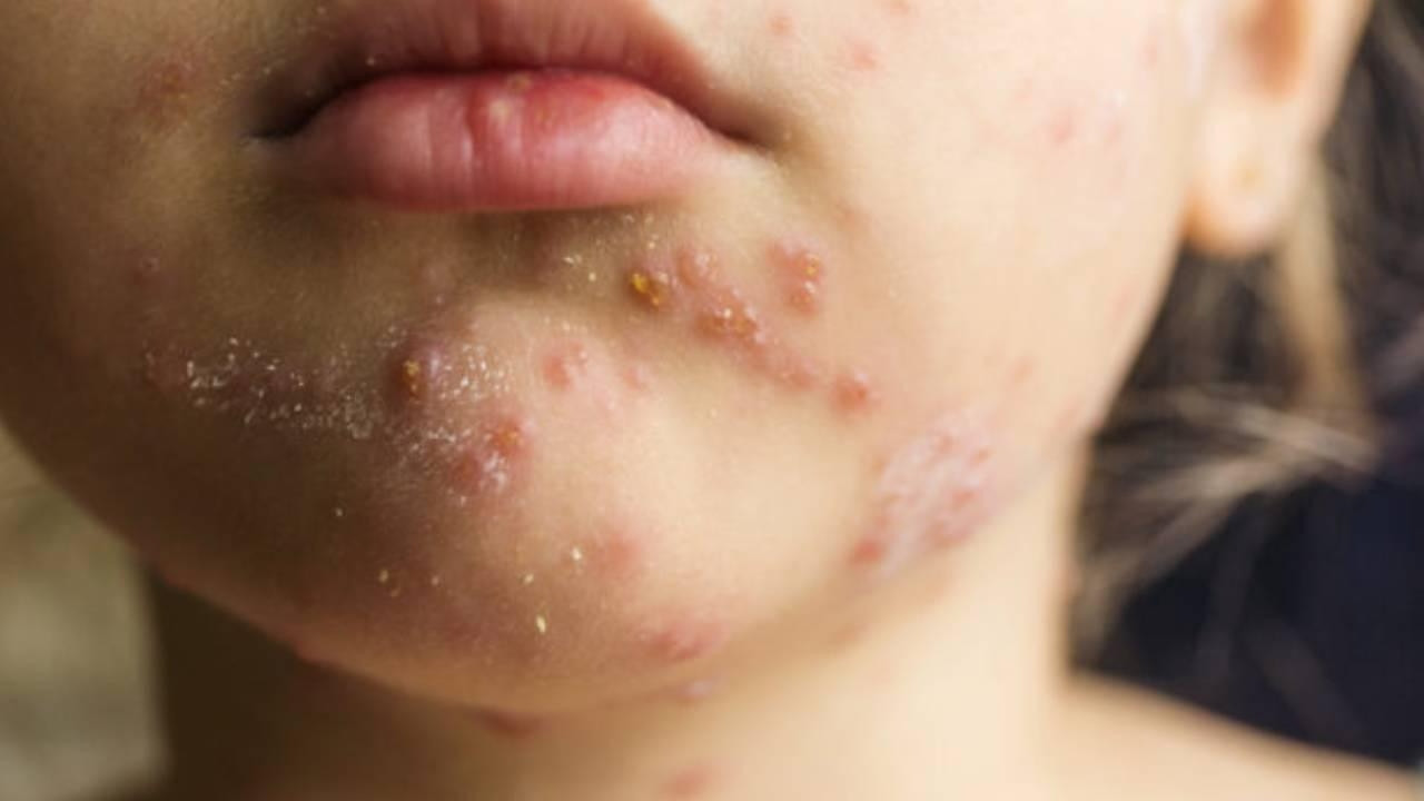 ABD'de 10 yıl aradan sonra kızamıktan ilk ölüm!