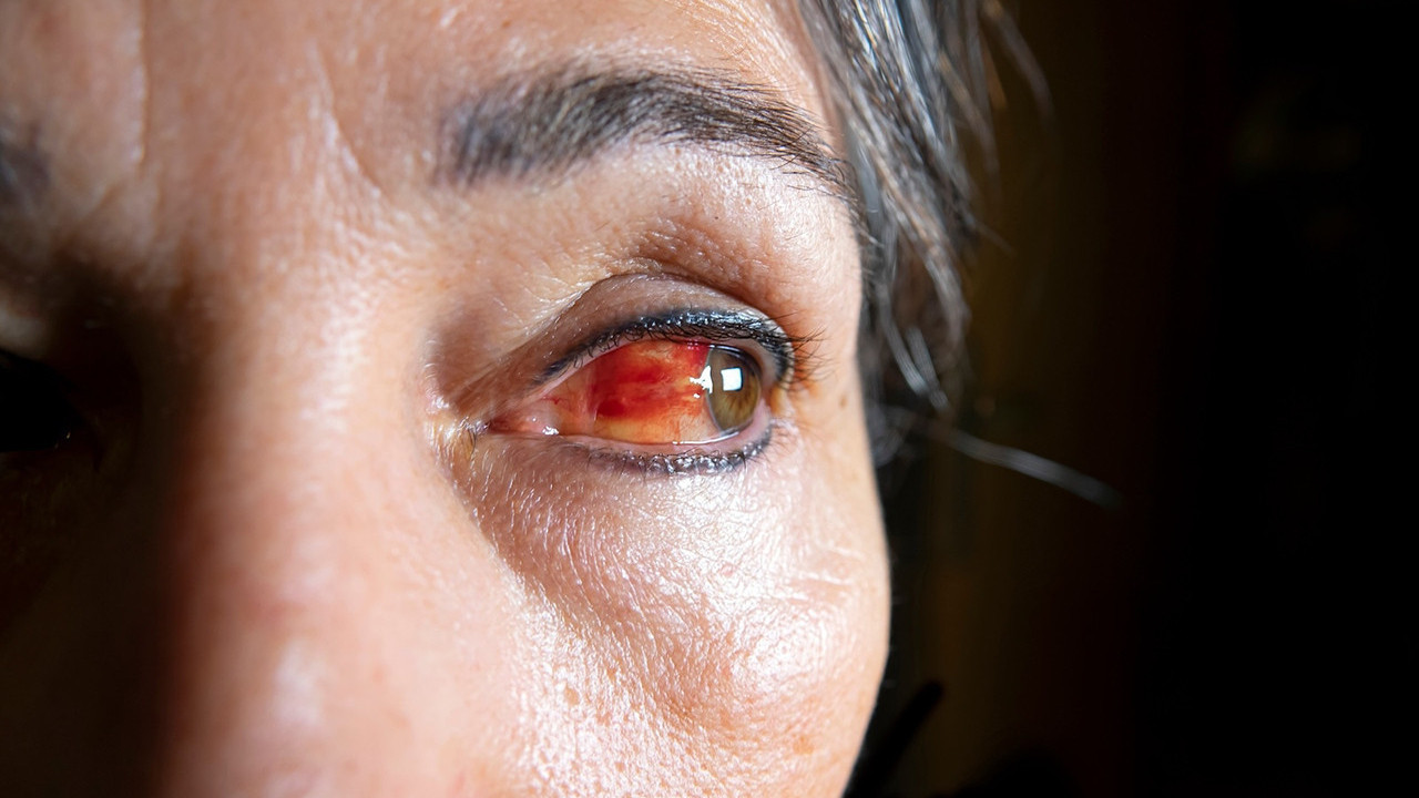 Öksürme bile göz altı kanaması yapabilir