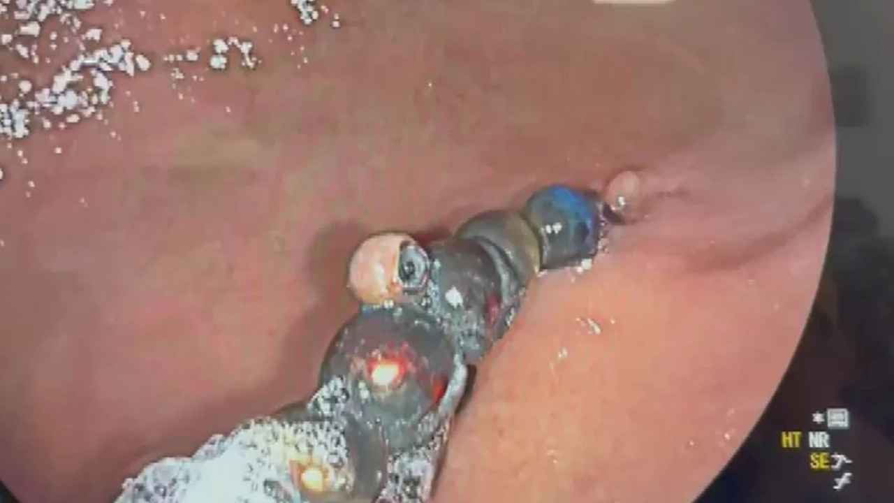 Doktorlar şoke oldu: 3 yaşındaki çocuğun midesinden çıkanlar hayrete düşürdü