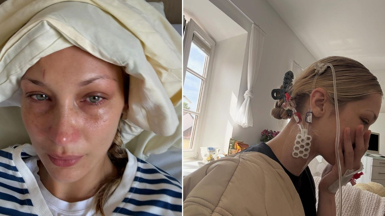 Bella Hadid’in hastalığı Lyme nedir, belirtileri neler? Zoonotik bir enfeksiyon hastalığı