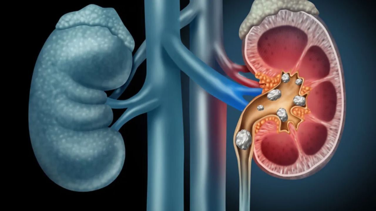 Böbrek taşına dikkat! Uzman isimden kritik uyarı