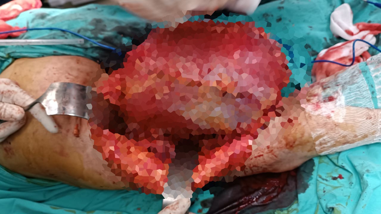 Hastanın bacağından bakın ne çıktı! Doktor bile şaşırdı...