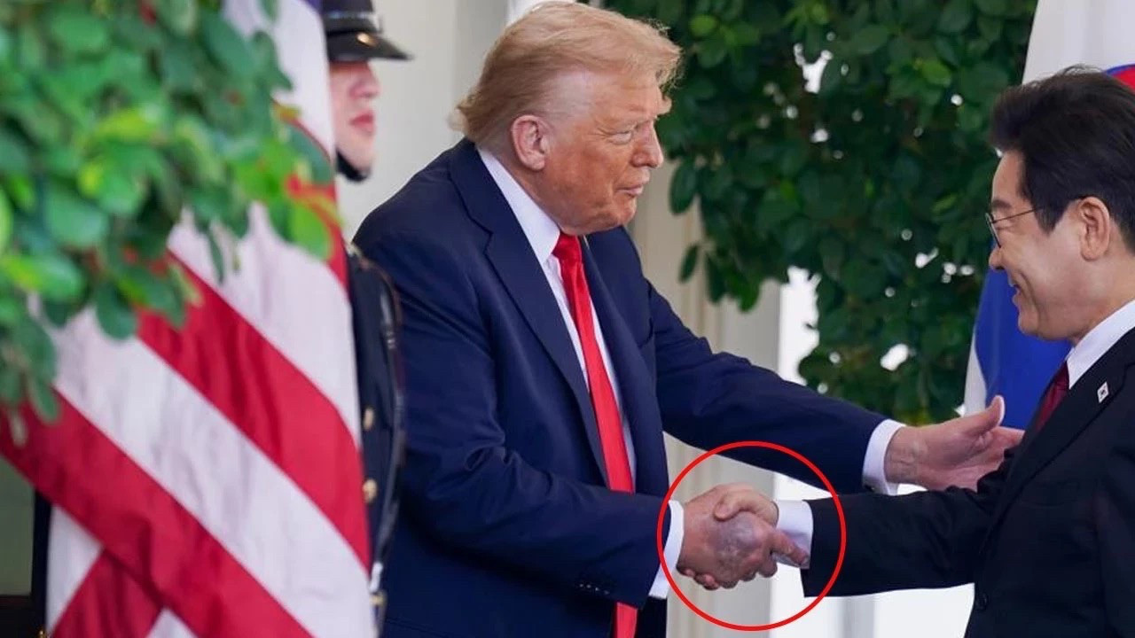 Trump, elindeki morluğun sebebini açıkladı