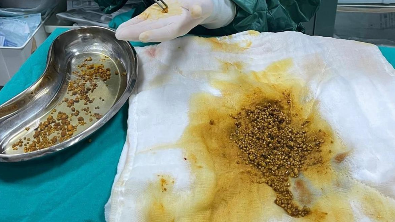 Hastanın ameliyatında 2 bin 67 taş çıkarıldı