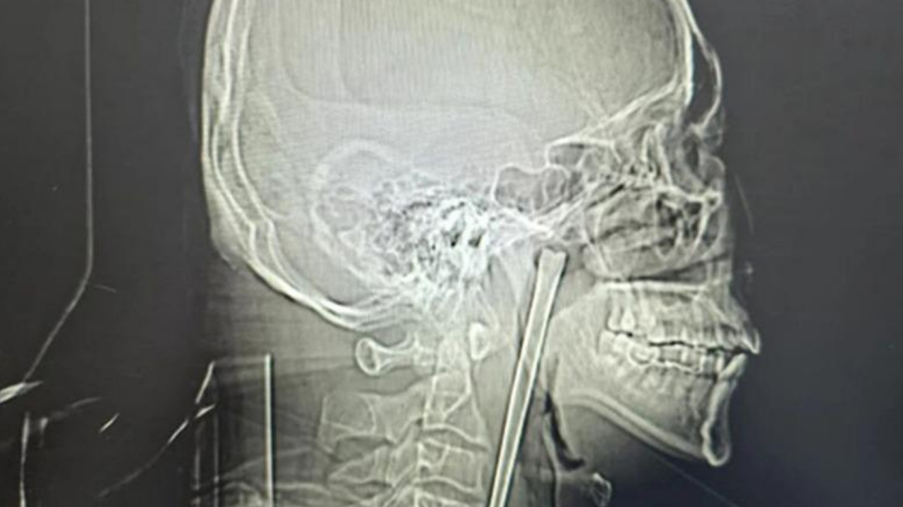 Boğazından çıkana doktor da inanamadı! Yıllarca böyle yaşamış