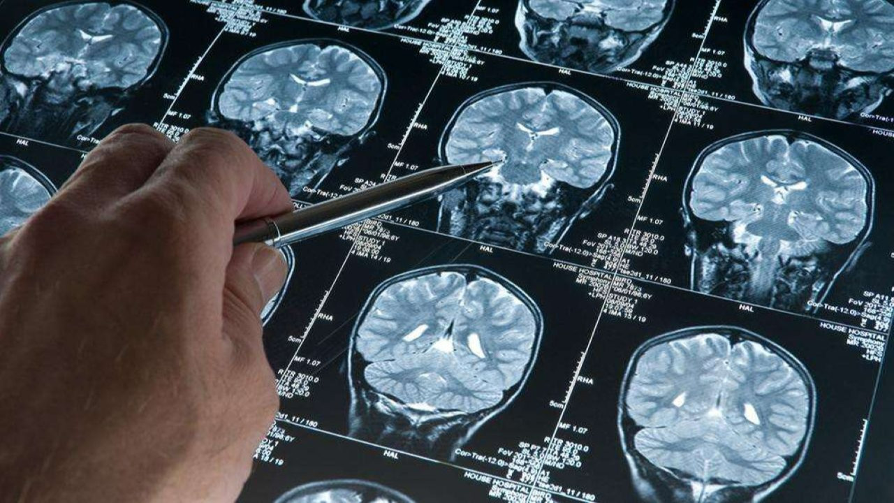 Yeni araştırma: Alzheimer belirtilerinin gizli evresine dikkat