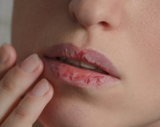 Dudak çatlaması nasıl geçer: En etkili 7 önlem