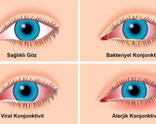 Göz sağlığı uzmanı uyardı: Tedavi edilmezse kalıcı hasar oluşur