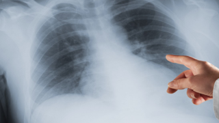 Araştırma: Akciğer kanseri ve beslenme arasında bağlantı olabilir