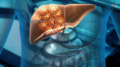 Türkiye’de her 2 kişiden birinde görülüyor! O meyve ile azaltmak mümkün...