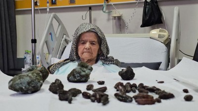 92 yaşındaki kadının midesinden ve bağırsaklarından çıkanlar şoke etti!