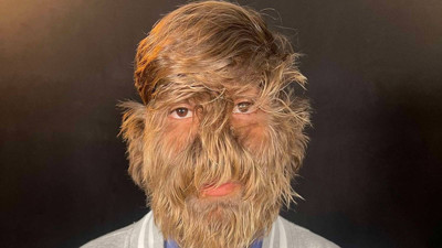 Dünyanın en kıllı yüzü seçildi: Nadir bir sendromla doğdu...