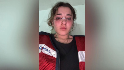 Tatilde dehşet! Genç kadına kaskla vurdu, 'Seni öldürürüm' diyerek burnunu kırdı