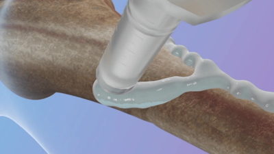 Çinli bilim insanları, kırıkları 3 dakikada iyileştiren 'kemik yapıştırıcısı' geliştirdi!