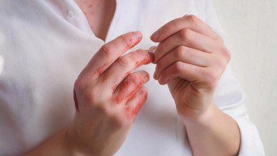 Bu hastalık 25 yaş altı genç erkeklerde daha belirgin!