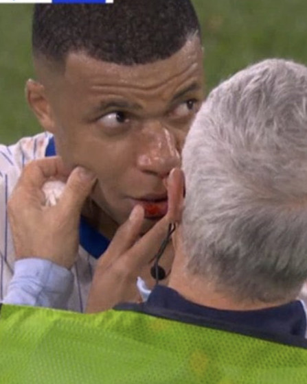 Yıldız oyuncudan şok haber! Mbappe'nin burnu kırıldı - Resim : 1