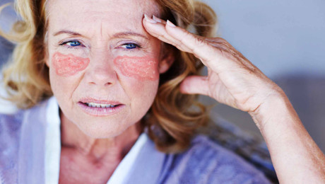 Lupus hastalığı nedir? Lupus nasıl ortaya çıkar? Hangi ünlülerde Lupus hastalığı var?