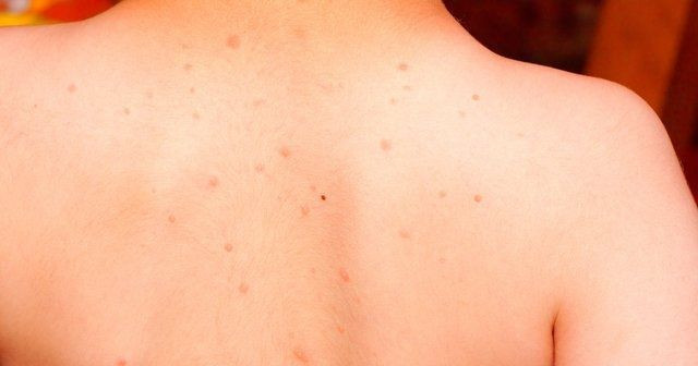 Uzman isim uyardı: Bu hata cilt lekelerine neden oluyor! - Resim: 13