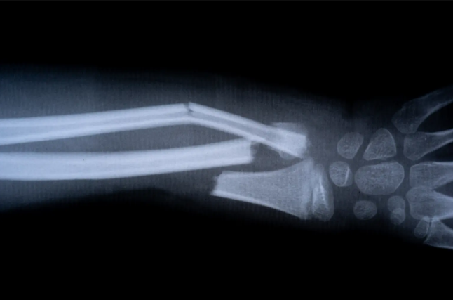 Çinli bilim insanları, kırıkları 3 dakikada iyileştiren 'kemik yapıştırıcısı' geliştirdi! - Resim: 1