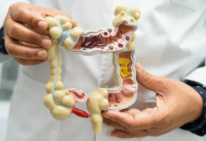 Divertiküler kanama nedir, neden olur? Murat Cimcir'den ötürü merak ediliyor