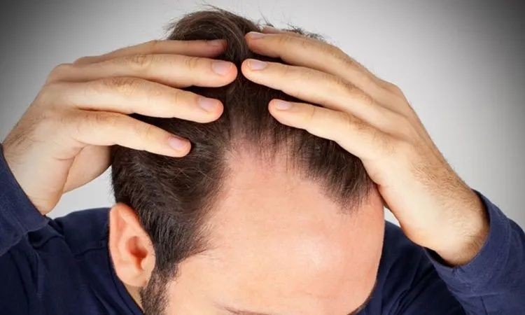 Saç dökülmesine ne iyi gelir? Bu yöntemleri mutlaka deneyin - Resim: 4