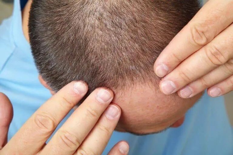 Saç dökülmesine ne iyi gelir? Bu yöntemleri mutlaka deneyin - Resim: 10