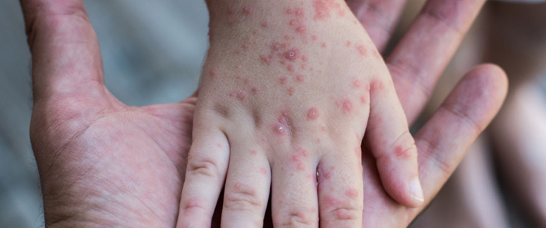 ABD'de 10 yıl aradan sonra kızamıktan ilk ölüm! - Resim : 1