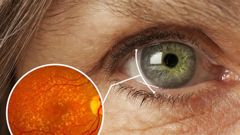 Hekimime soruyorum: Gözlerde makula dejeneresansı düzenli takip ve kontrol ister