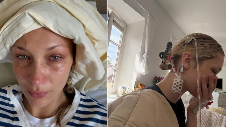 Bella Hadid’in hastalığı Lyme nedir, belirtileri neler? Zoonotik bir enfeksiyon hastalığı