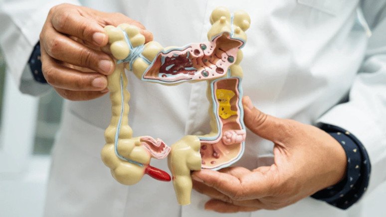 Divertiküler kanama nedir, neden olur? Murat Cimcir'den ötürü merak ediliyor