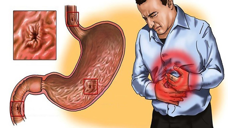 Mide ülseri nedir? Mide reflüsü ile mide ülserinin farkı ne? - Resim : 2