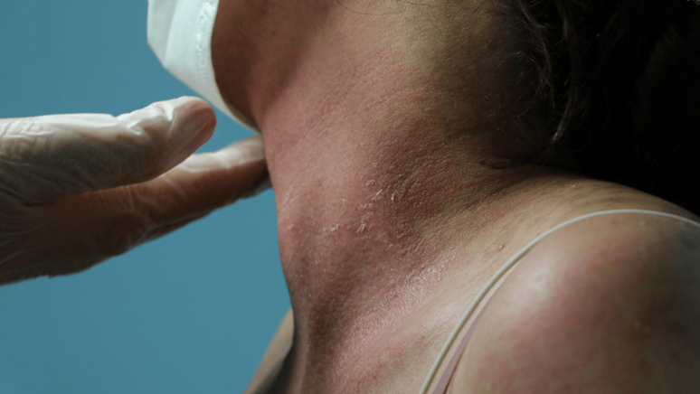 İnternetten aldığı krem canına mal oluyordu! - Resim : 1