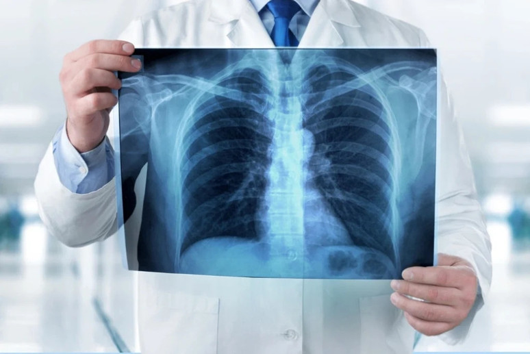 Araştırma: Akciğer kanseri ve beslenme arasında bağlantı olabilir - Resim : 1