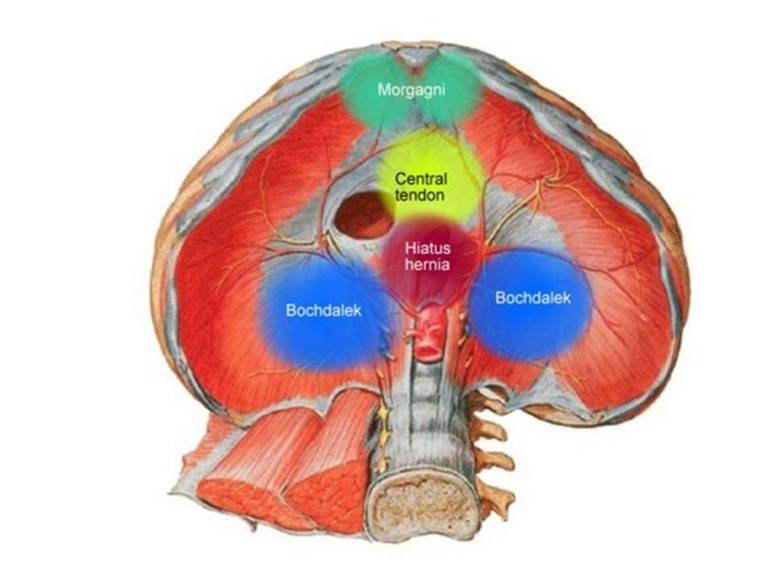 Bochdalek hernisi - Resim : 1