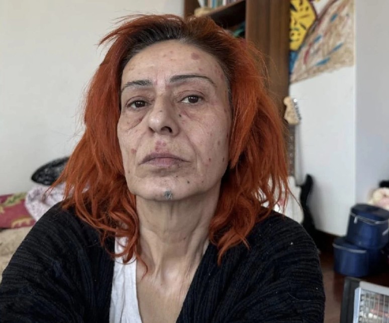 Yıldız Tilbe'den kötü haber! Yüzü yandı tedavi altına alındı - Resim : 1