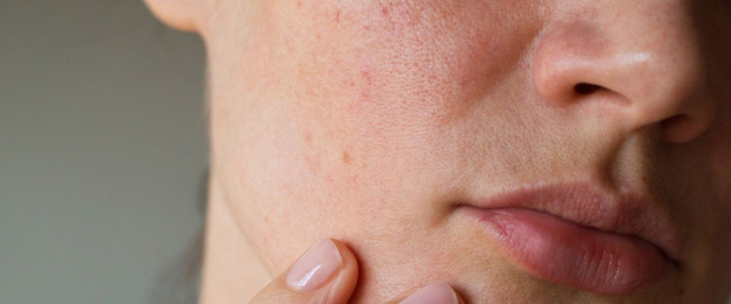 Uzman isim uyardı: Bu hata cilt lekelerine neden oluyor! - Resim: 4