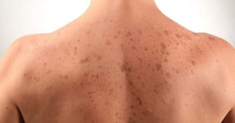 Uzman isim uyardı: Bu hata cilt lekelerine neden oluyor! - Resim: 7